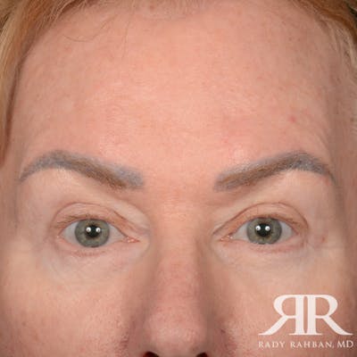Eyelid Surgery Before & After Gallery - Patient 169302 - Image 2