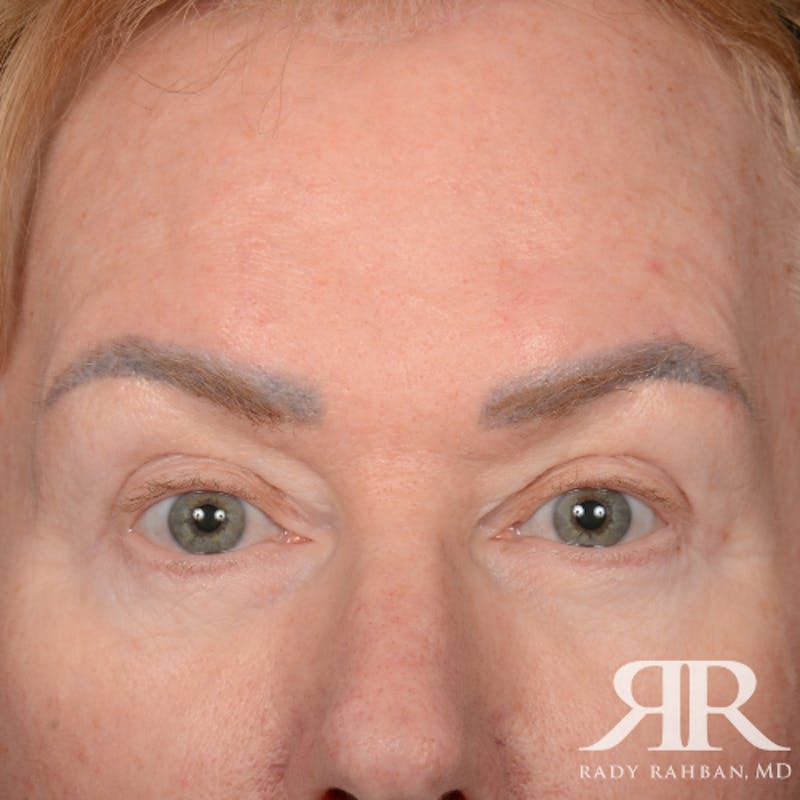 Eyelid Surgery Before & After Gallery - Patient 169302 - Image 2