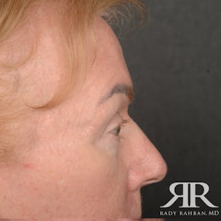 Eyelid Surgery Before & After Gallery - Patient 169302 - Image 6