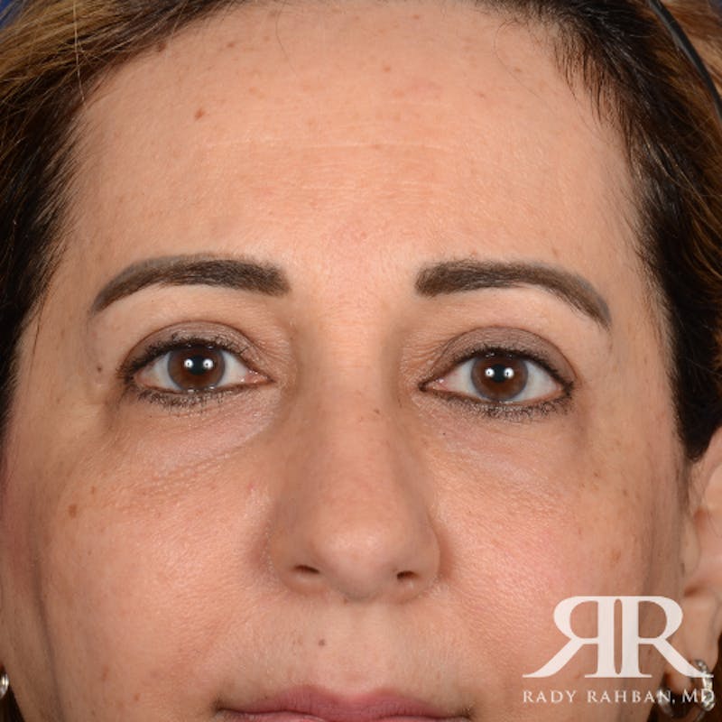 Eyelid Surgery Before & After Gallery - Patient 228006 - Image 2