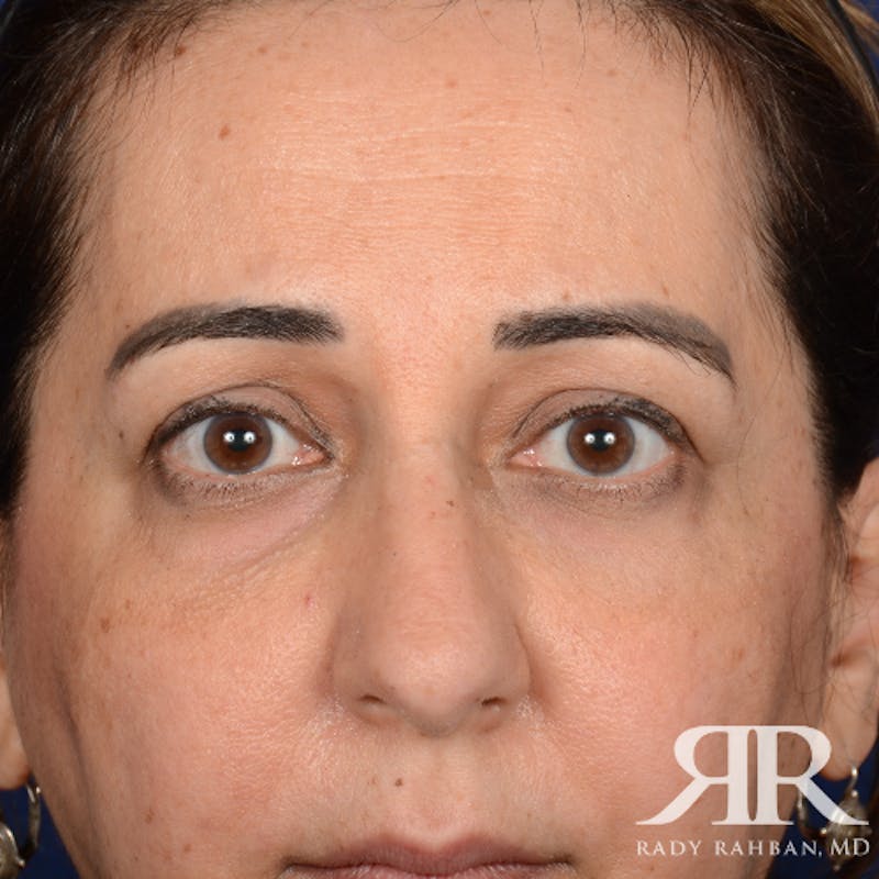 Eyelid Surgery Before & After Gallery - Patient 228006 - Image 1