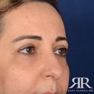Eyelid Surgery Before & After Gallery - Patient 228006 - Image 4