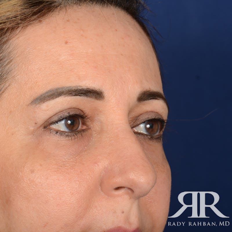 Eyelid Surgery Before & After Gallery - Patient 228006 - Image 4