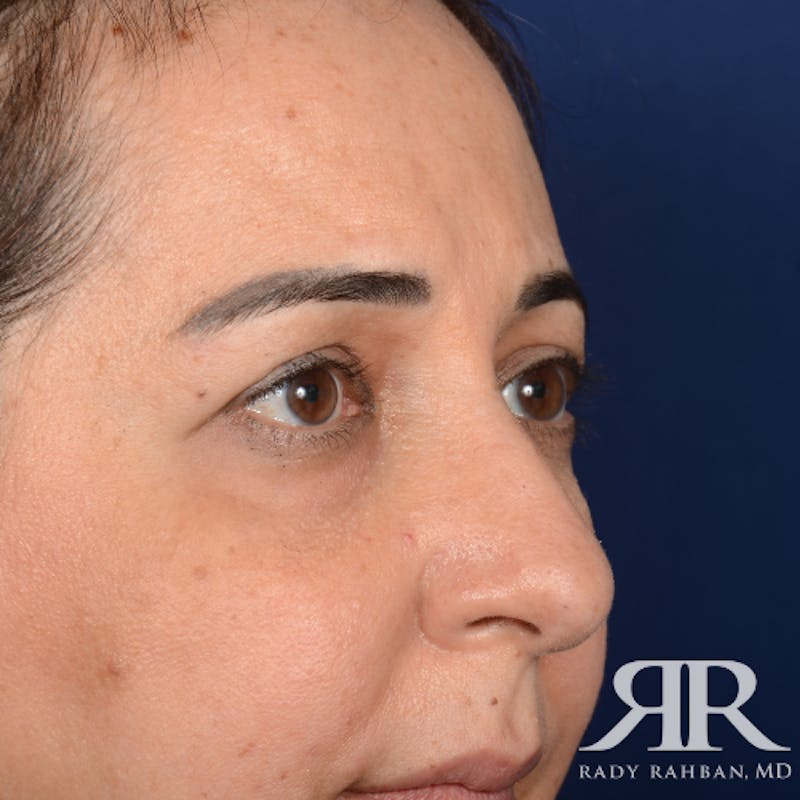 Eyelid Surgery Before & After Gallery - Patient 228006 - Image 3