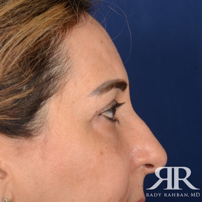 Eyelid Surgery Before & After Gallery - Patient 228006 - Image 6