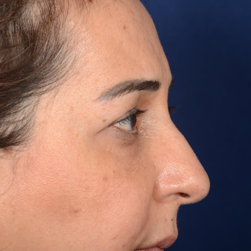 Eyelid Surgery Before & After Gallery - Patient 228006 - Image 5