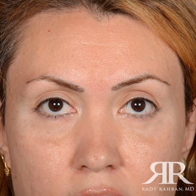 Eyelid Surgery Before & After Gallery - Patient 204414 - Image 2