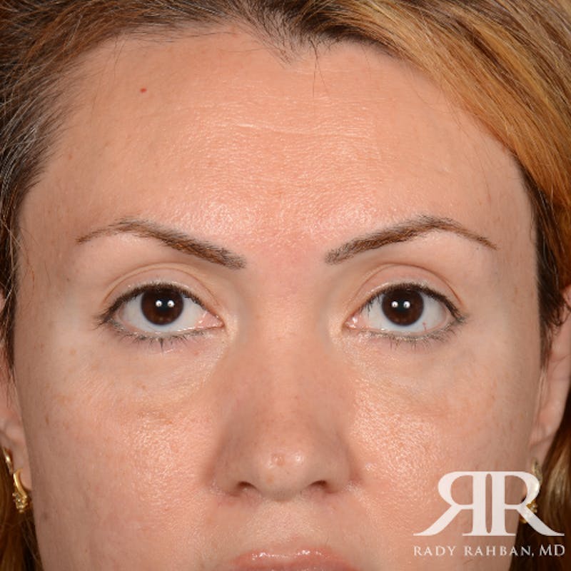 Eyelid Surgery Before & After Gallery - Patient 204414 - Image 2
