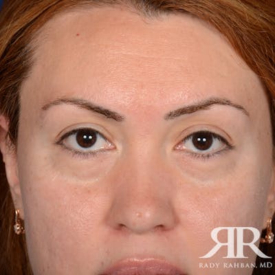 Eyelid Surgery Before & After Gallery - Patient 204414 - Image 1