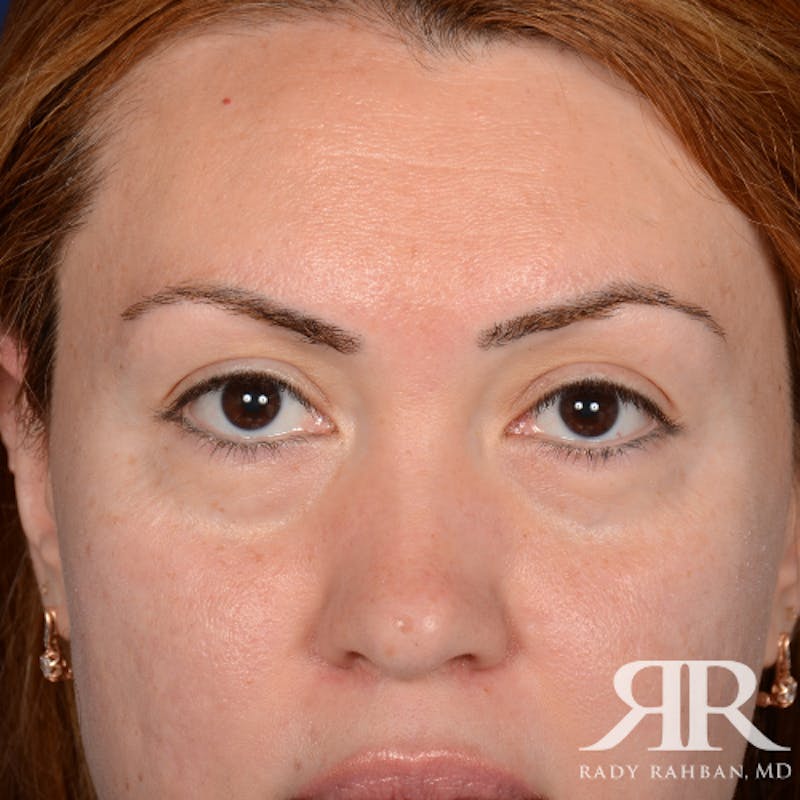 Eyelid Surgery Before & After Gallery - Patient 204414 - Image 1