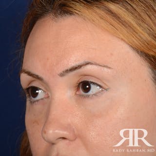 Eyelid Surgery Before & After Gallery - Patient 204414 - Image 4