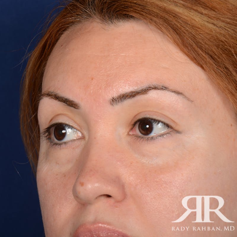 Eyelid Surgery Before & After Gallery - Patient 204414 - Image 3