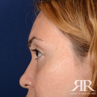 Eyelid Surgery Before & After Gallery - Patient 204414 - Image 6