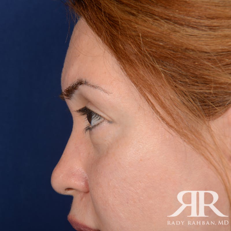 Eyelid Surgery Before & After Gallery - Patient 204414 - Image 5