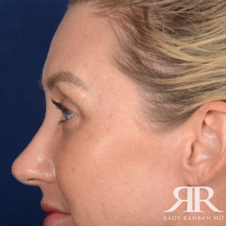 Eyelid Surgery Before & After Gallery - Patient 185613 - Image 4