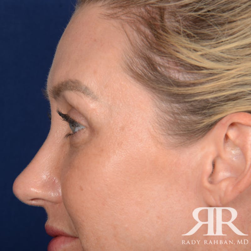 Eyelid Surgery Before & After Gallery - Patient 185613 - Image 4