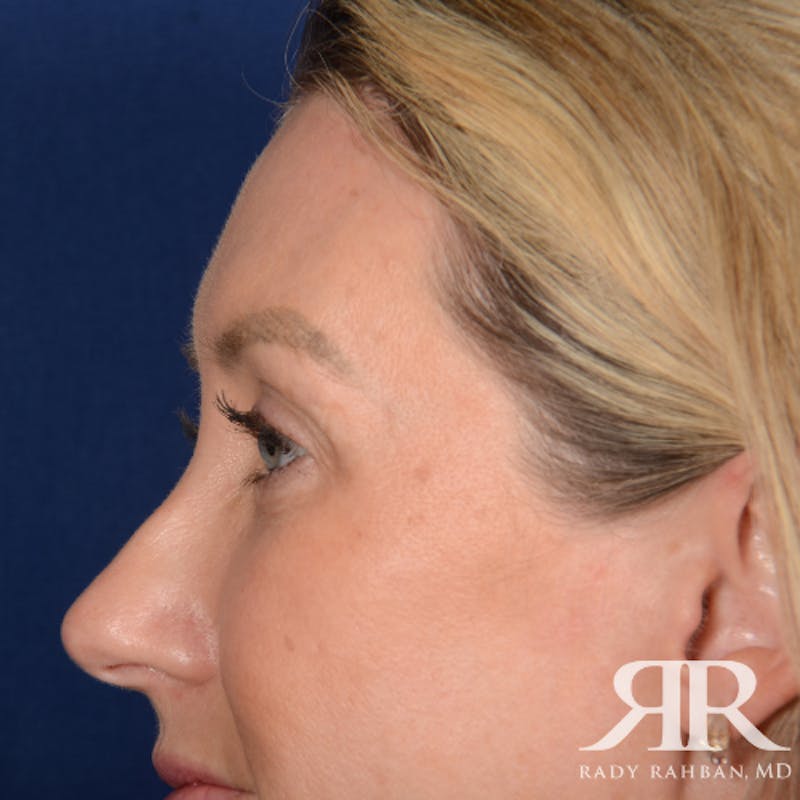 Eyelid Surgery Before & After Gallery - Patient 185613 - Image 3