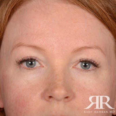 Eyelid Surgery Before & After Gallery - Patient 194845 - Image 2