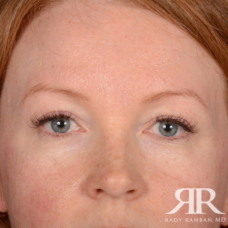 Eyelid Surgery Before & After Gallery - Patient 194845 - Image 2