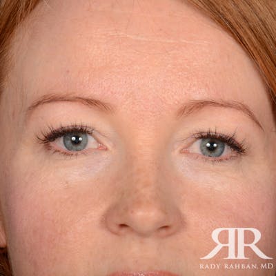 Eyelid Surgery Before & After Gallery - Patient 194845 - Image 1