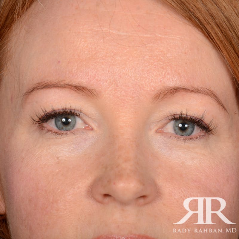 Eyelid Surgery Before & After Gallery - Patient 194845 - Image 1