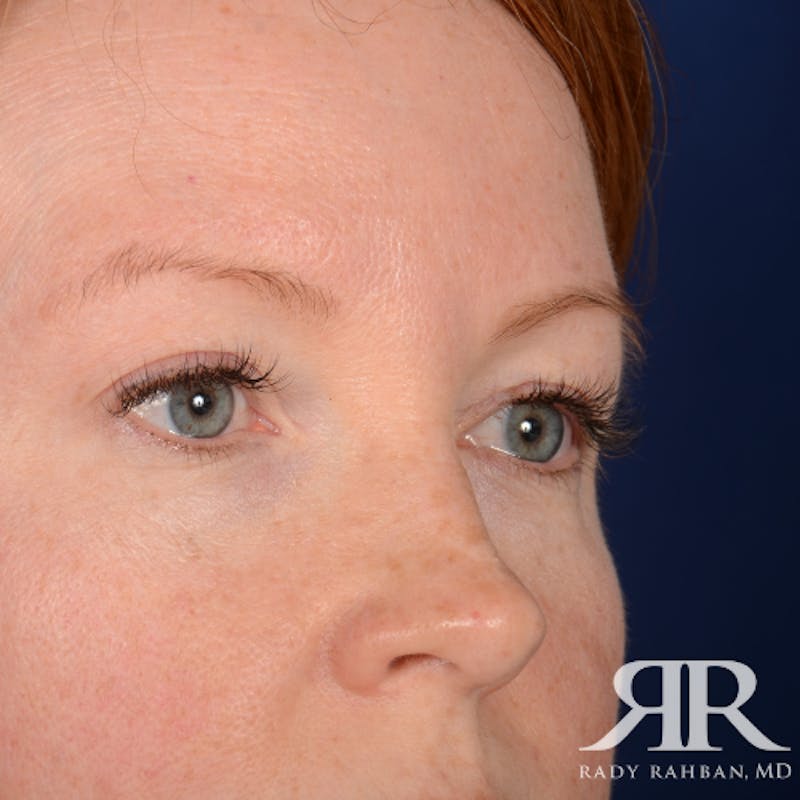 Eyelid Surgery Before & After Gallery - Patient 194845 - Image 4