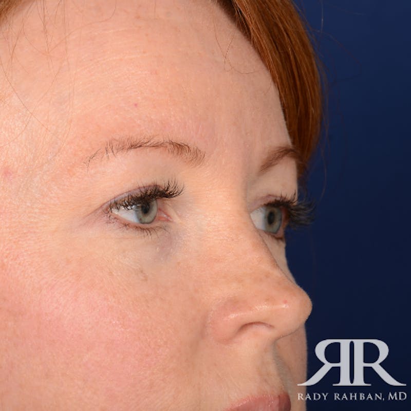 Eyelid Surgery Before & After Gallery - Patient 194845 - Image 3