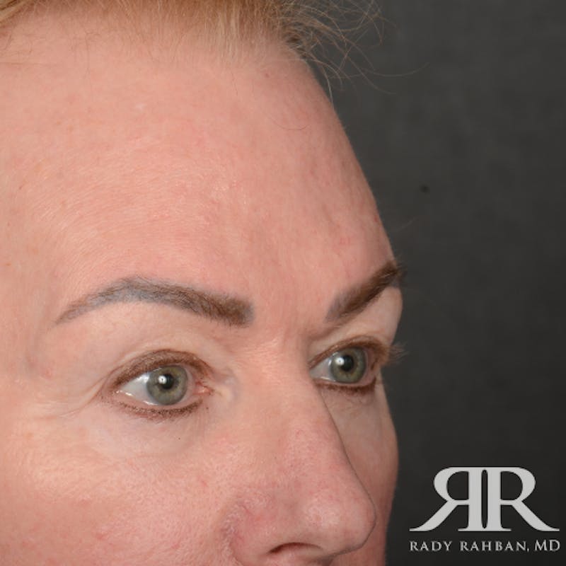 Eyelid Surgery Before & After Gallery - Patient 169302 - Image 3