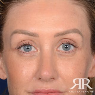 Eyelid Surgery Before & After Gallery - Patient 185613 - Image 2