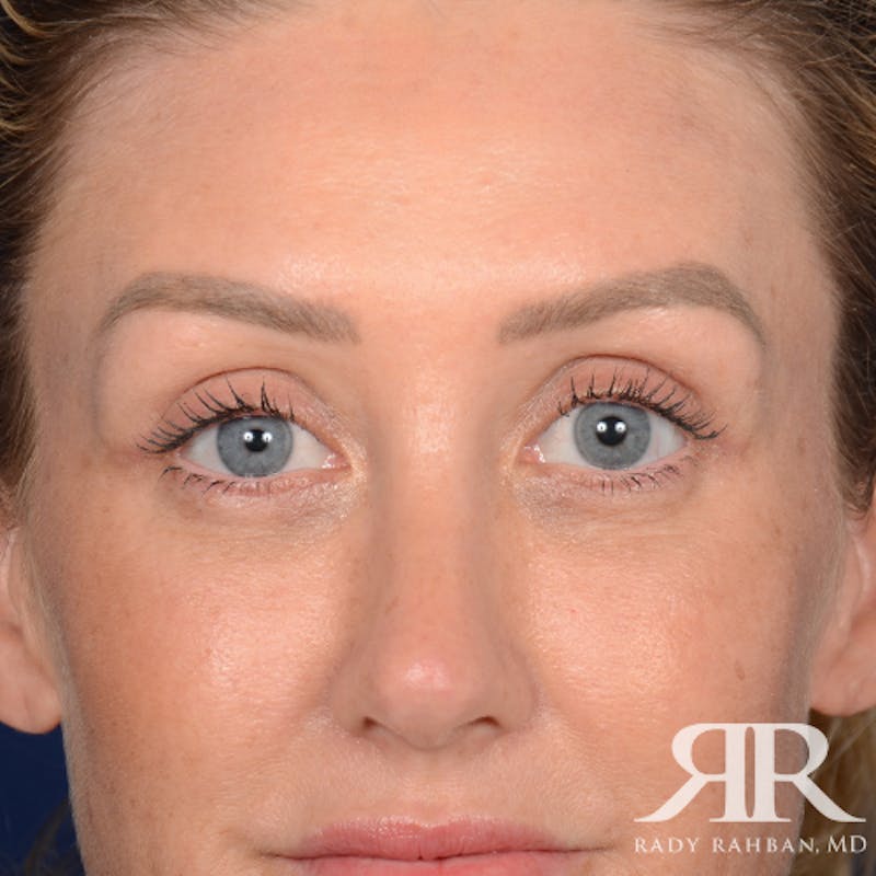 Eyelid Surgery Before & After Gallery - Patient 185613 - Image 2