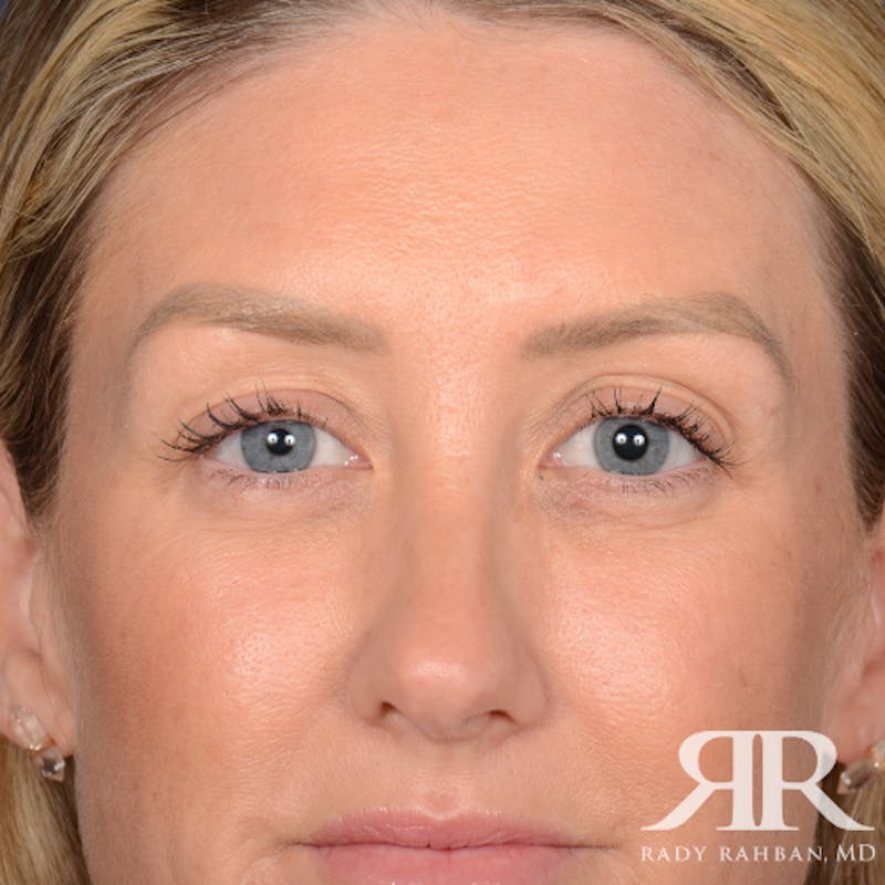 Eyelid Surgery Before & After Gallery - Patient 185613 - Image 1