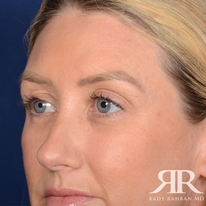 Eyelid Surgery Before & After Gallery - Patient 185613 - Image 5