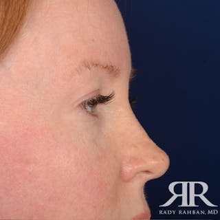 Eyelid Surgery Before & After Gallery - Patient 194845 - Image 6