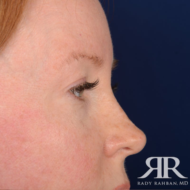 Eyelid Surgery Before & After Gallery - Patient 194845 - Image 6