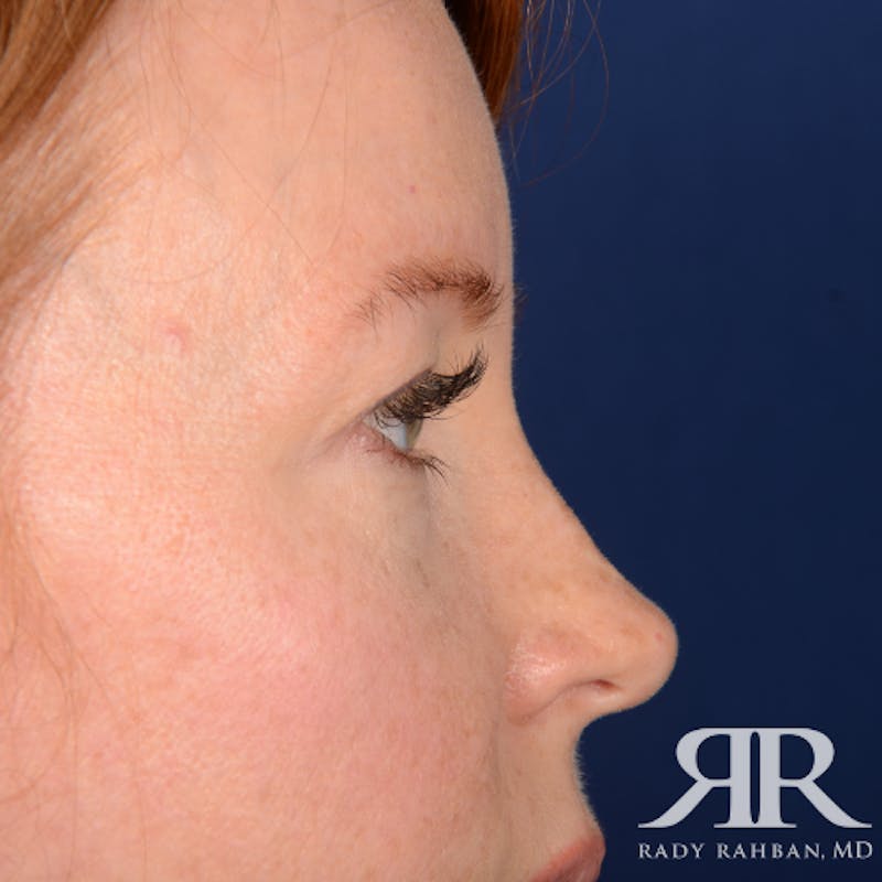 Eyelid Surgery Before & After Gallery - Patient 194845 - Image 5