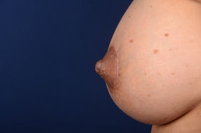 Nipple Reduction Before & After Gallery - Patient 288527 - Image 2