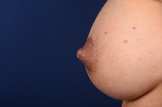 Nipple Reduction Before & After Gallery - Patient 288527 - Image 2