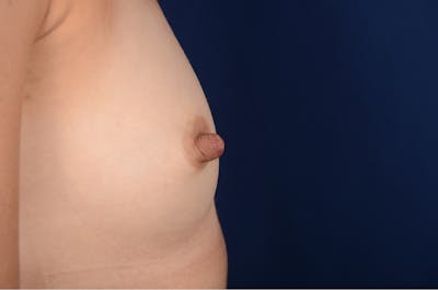Nipple Reduction Before & After Gallery - Patient 137634 - Image 1