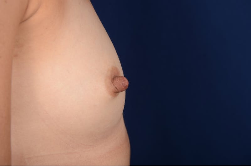 Nipple Reduction Before & After Gallery - Patient 137634 - Image 1