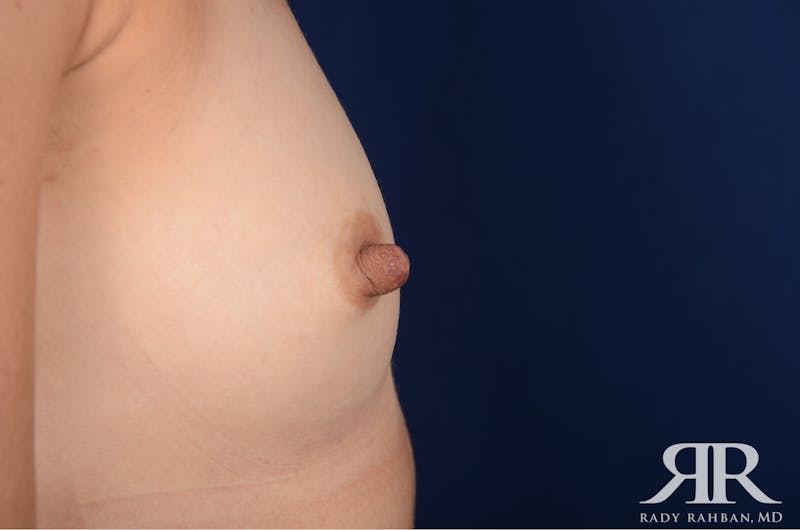 Nipple Reduction Before & After Gallery - Patient 137634 - Image 1