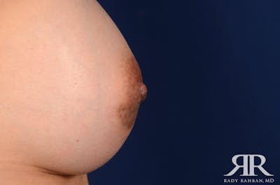 Nipple Reduction Before & After Gallery - Patient 270009 - Image 2