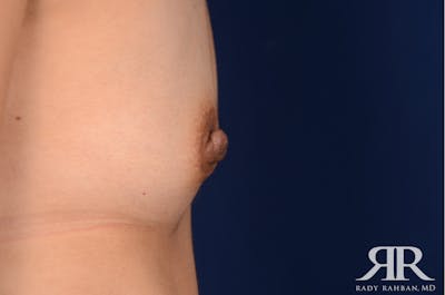 Nipple Reduction Before & After Gallery - Patient 270009 - Image 1