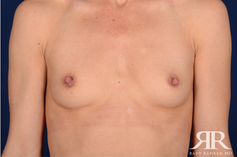 Nipple Reduction Before & After Gallery - Patient 402903 - Image 3