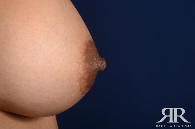 Nipple Reduction Before & After Gallery - Patient 102103 - Image 2