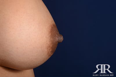 Nipple Reduction Before & After Gallery - Patient 102103 - Image 2