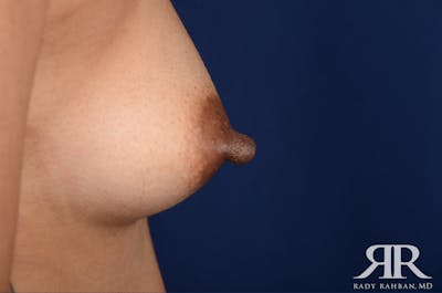Nipple Reduction Before & After Gallery - Patient 102103 - Image 1