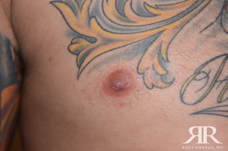 Nipple Reduction Before & After Gallery - Patient 810159 - Image 6