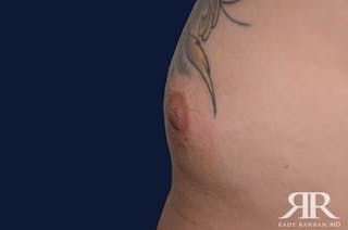 Nipple Reduction Before & After Gallery - Patient 810159 - Image 4