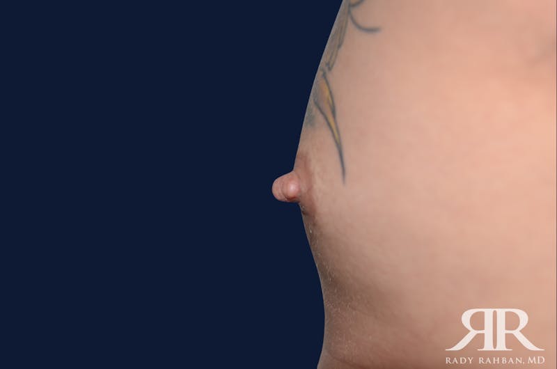 Nipple Reduction Before & After Gallery - Patient 810159 - Image 3