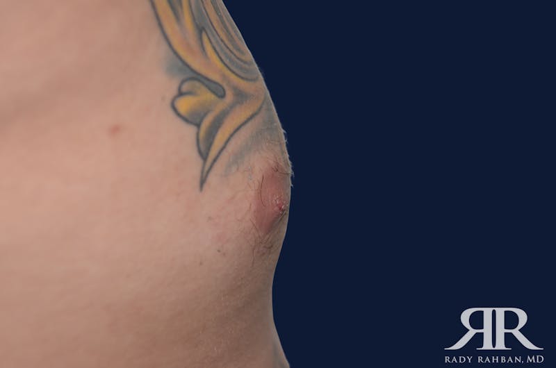 Nipple Reduction Before & After Gallery - Patient 810159 - Image 2